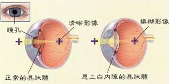 淺談白內障的臨床表現