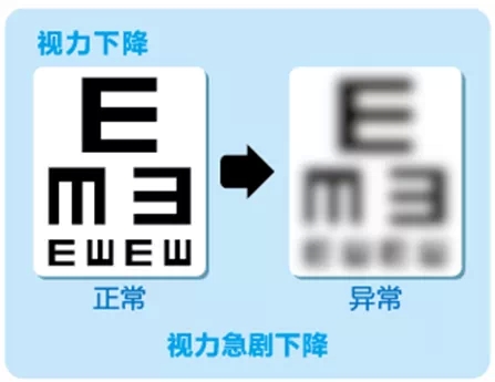 視網(wǎng)膜脫離啥癥狀？這張圖告訴你！