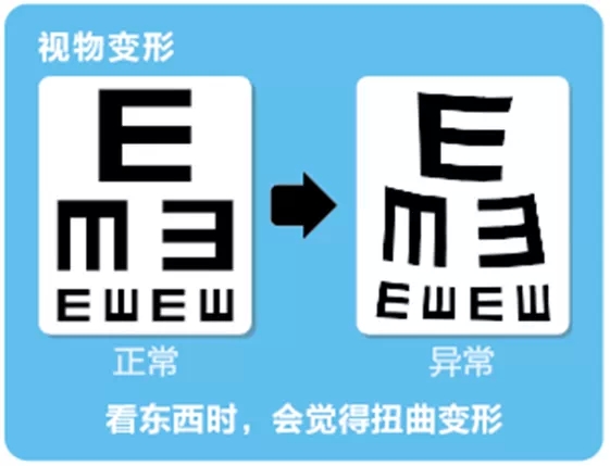 視網(wǎng)膜脫離啥癥狀？這張圖告訴你！