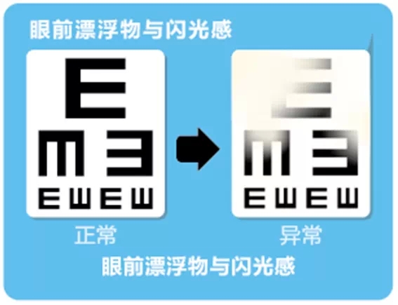 視網(wǎng)膜脫離啥癥狀？這張圖告訴你！