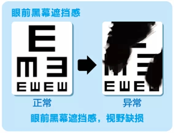 視網(wǎng)膜脫離啥癥狀？這張圖告訴你！