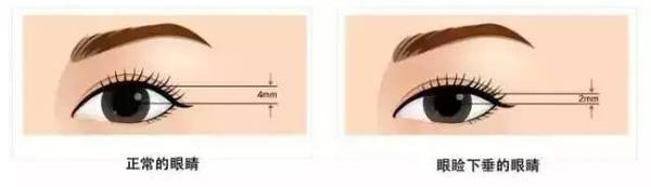 為什么要做雙眼皮？5個(gè)理由說(shuō)服你！