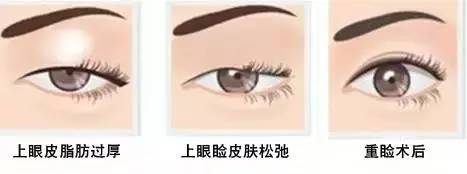 為什么要做雙眼皮？5個(gè)理由說(shuō)服你！