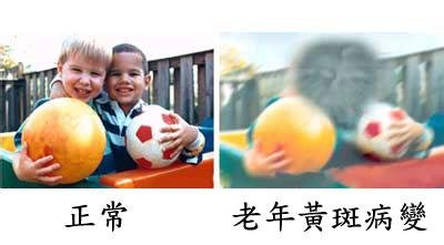 黃斑變性與老花眼，兩者不一樣！