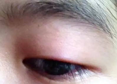“美目貼”別依賴，小心眼皮下垂