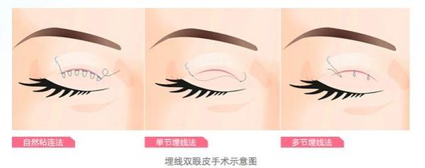 眼整形的恢復(fù)期是多長？你肯定想知道！