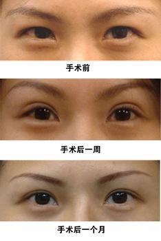 眼整形的恢復(fù)期是多長？你肯定想知道！