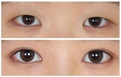 眼整形的恢復(fù)期是多長？你肯定想知道！