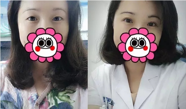 要不要做雙眼皮？別糾結(jié)了看這個！