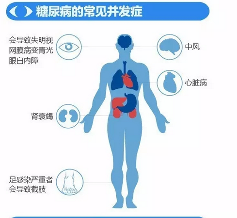 你造嗎？糖尿病晚期眼睛會致盲！