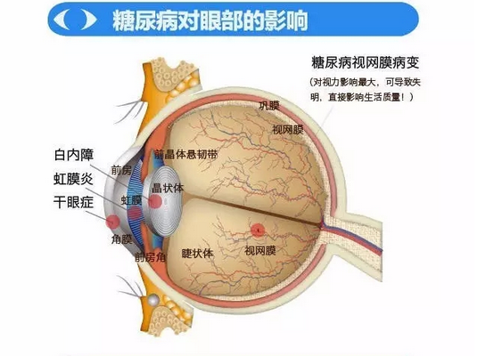 你造嗎？糖尿病晚期眼睛會致盲！