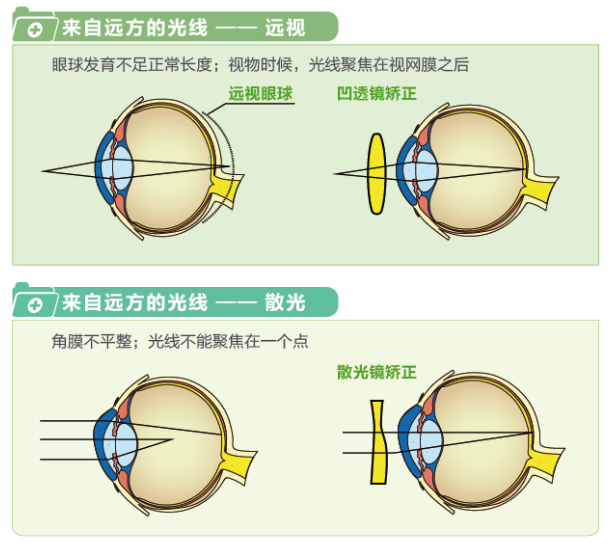 【看圖解】一張圖教你看懂近視、遠視和散光