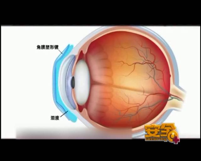 一夜之間真的能改變視力嗎？