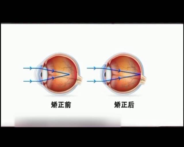 一夜之間真的能改變視力嗎？