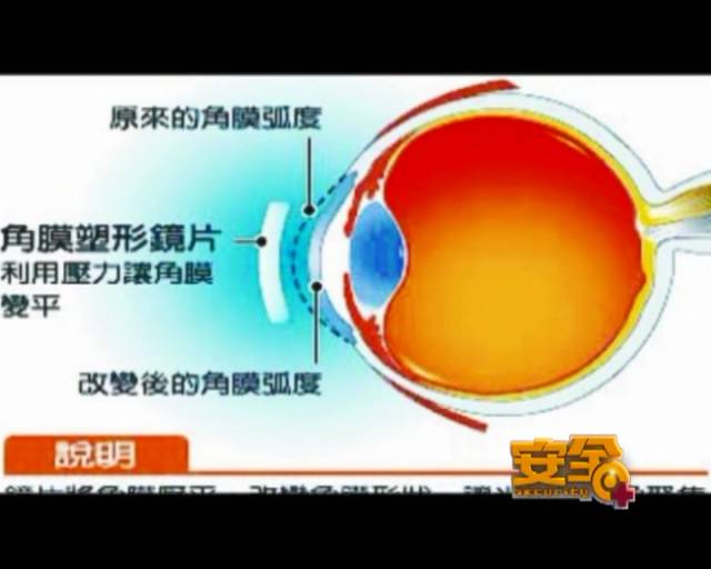 一夜之間真的能改變視力嗎？