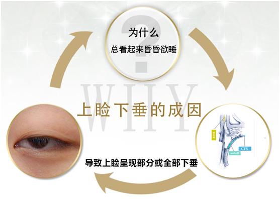 拯救惺忪睡眼，告別上瞼下垂！