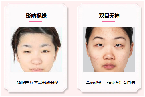 拯救惺忪睡眼，告別上瞼下垂！