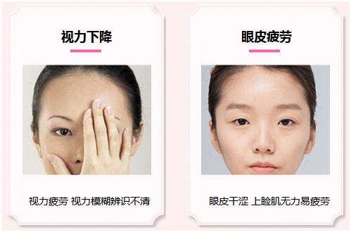 拯救惺忪睡眼，告別上瞼下垂！