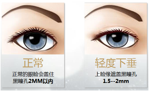 拯救惺忪睡眼，告別上瞼下垂！