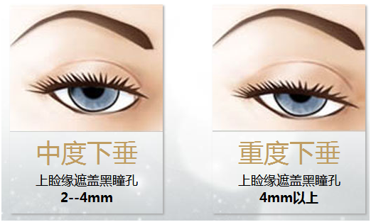 拯救惺忪睡眼，告別上瞼下垂！