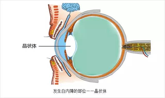 眼科主任告誡白內(nèi)障這幾大誤區(qū)，80%的老人上當(dāng)
