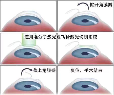 如果眼睛近視了該怎么？
