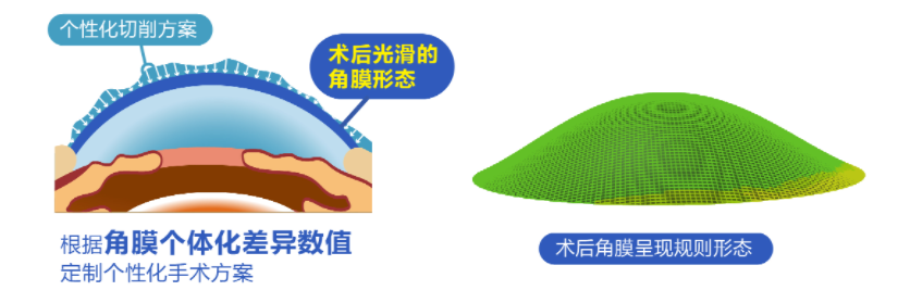 微雕優(yōu)視飛秒，重新定義角膜屈光手術(shù)，讓視力多看一行！