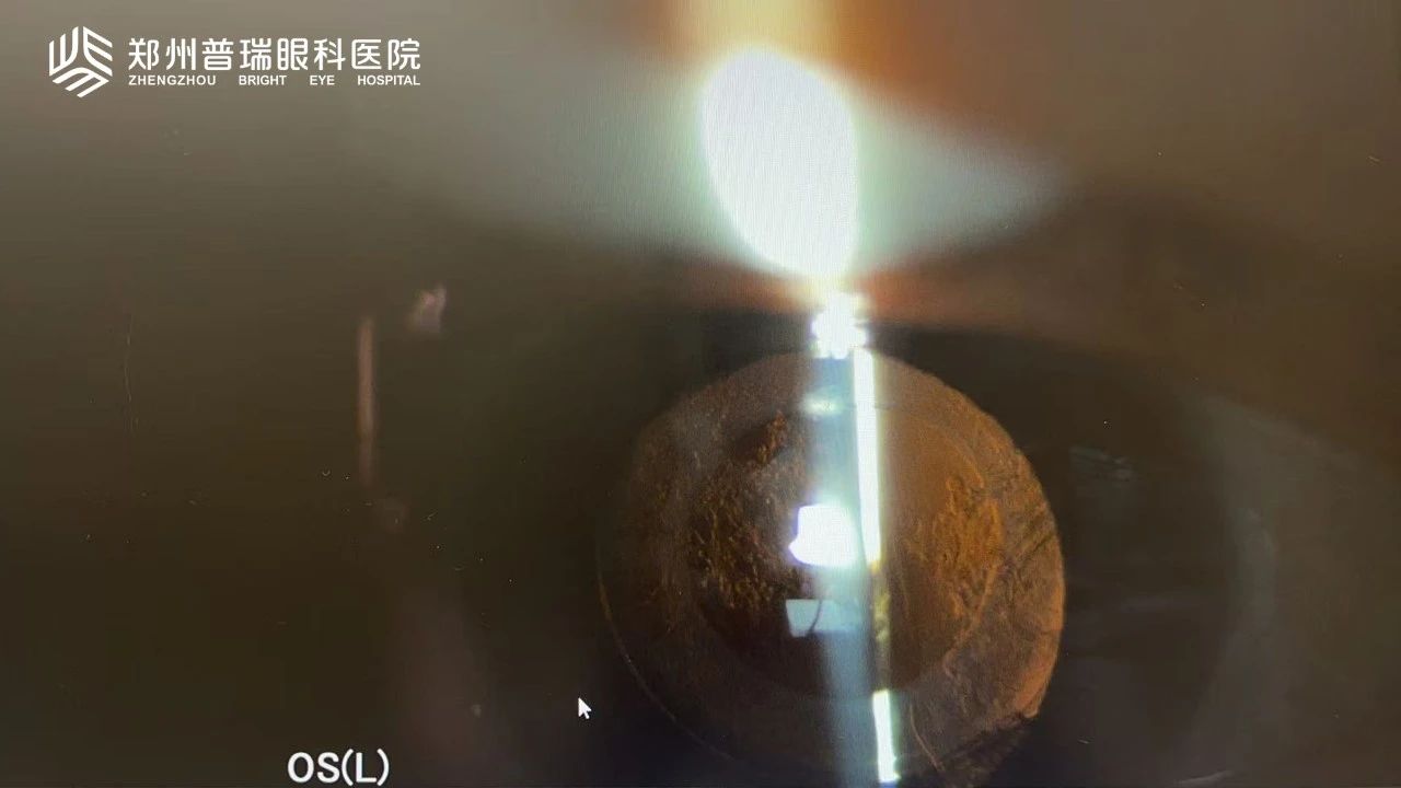 白內(nèi)障術(shù)后視力又下降？6大原因多方面解析！